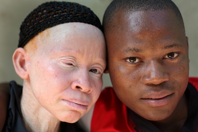  albinism-alodokter 