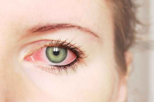  Nhiều cách khác nhau để khắc phục mắt đỏ - dsuckhoe 