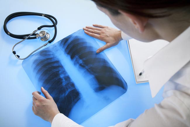  Các loại bệnh và thủ tục do các bác sĩ chuyên khoa phổi-dsuckhoe xử lý 