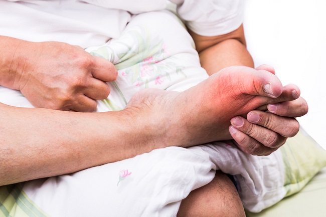 Các triệu chứng bệnh gút ở bàn chân quan trọng cần nhận biết - dsuckhoe