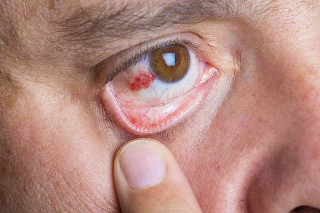  Hãy coi chừng bệnh đột quỵ ở mắt, Biết nguyên nhân và cách điều trị-dsuckhoe 