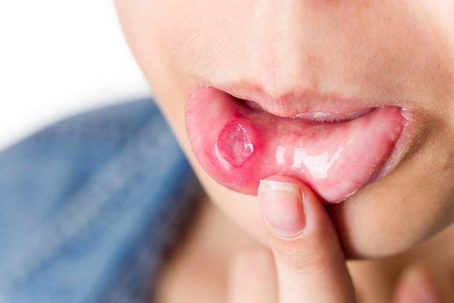  Biện pháp khắc phục bệnh tưa miệng cho trẻ mà cha mẹ cần biết -dsuckhoe 