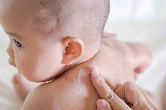  Xác định nguyên nhân gây ra đốm đỏ trên da của trẻ và cách điều trị-dsuckhoe 
