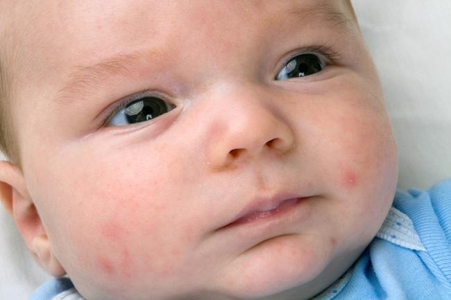  Vấn đề với làn da của em bé và cách điều trị nó-dsuckhoe 