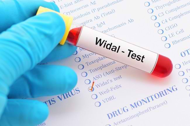  Tìm hiểu xét nghiệm Widal để chẩn đoán bệnh thương hàn 