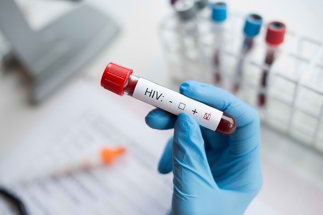  Xét nghiệm HIV và những điều quan trọng trong đó - dsuckhoe 