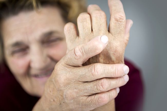 Bàn tay của người phụ nữ bị biến dạng do viêm khớp dạng thấp