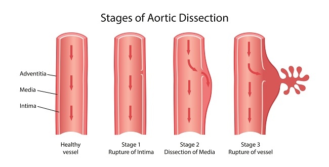 Aortic Dissection-dsuckhoe