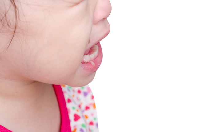 Nguyên nhân và cách khắc phục chứng tưa miệng ở trẻ sơ sinh-dsuckhoe 