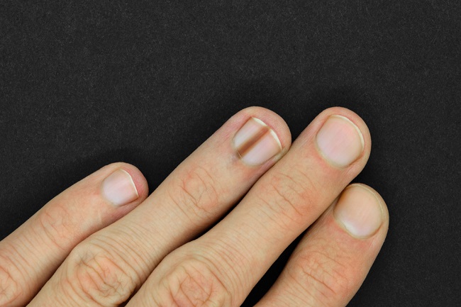  Nguyên nhân gây ra đường đen trên móng tay và cách điều trị vết đen trên móng tay 