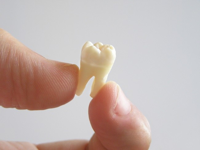  Nguyên nhân nhổ răng và cách khắc phục tình trạng nhổ răng 