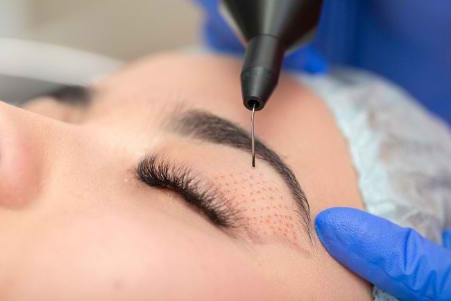  Những điều về phẫu thuật cắt mí mắt bạn nên biết-dsuckhoe 
