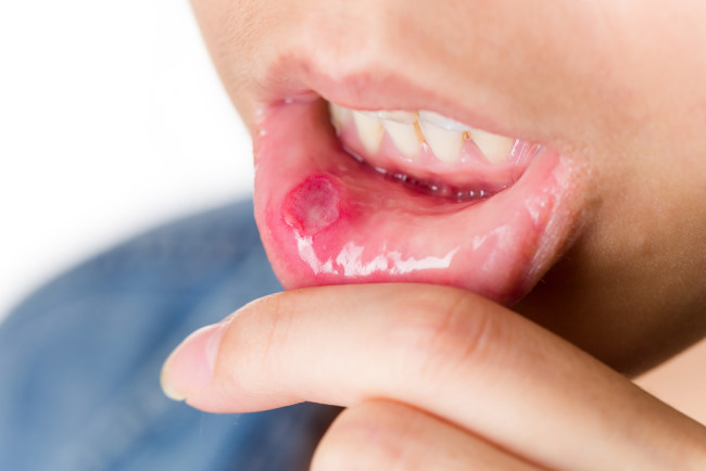  Nước súc miệng như một chất khử trùng trong việc duy trì răng miệng  - dsuckhoe 