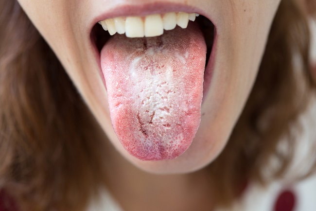 Woman, With, Halitosis, For, Candida, Albicans, On, Lưỡi 
