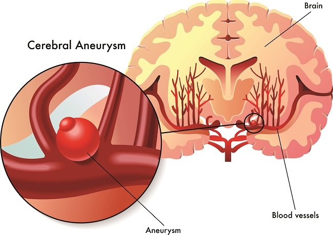Brain Aneurysm-dsuckhoe
