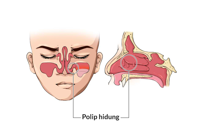  bệnh polyp mũi, triệu chứng, nguyên nhân, cách phòng ngừa, cách điều trị, alodokter 
