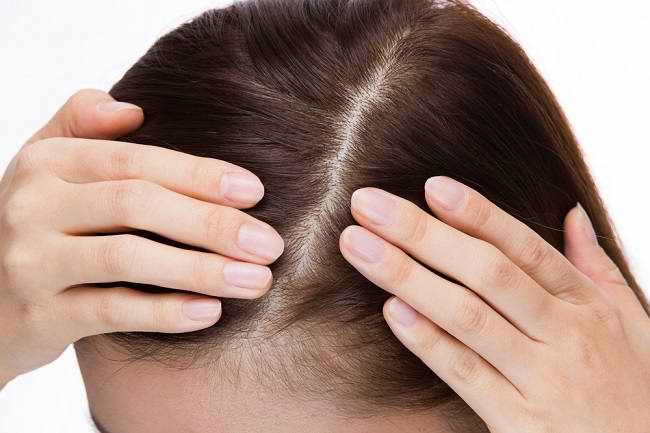  7 bệnh da đầu bạn cần biết - dsuckhoe 