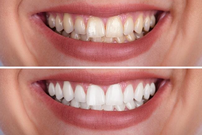  Nhiều cách Điều trị răng vàng tại nha sĩ - dsuckhoe 