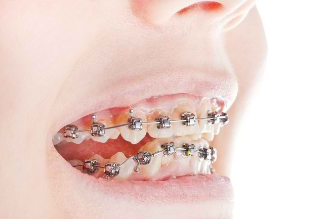  Răng bị gãy không có nghĩa là thế giới đã qua - dsuckhoe 
