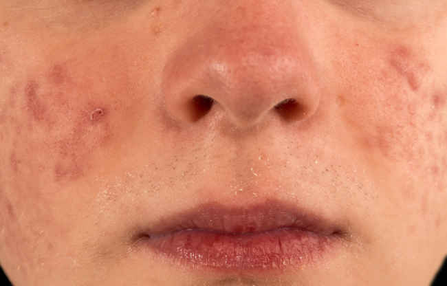  Điều trị Hoàn toàn Mụn nhọt trên da mặt-dsuckhoe 