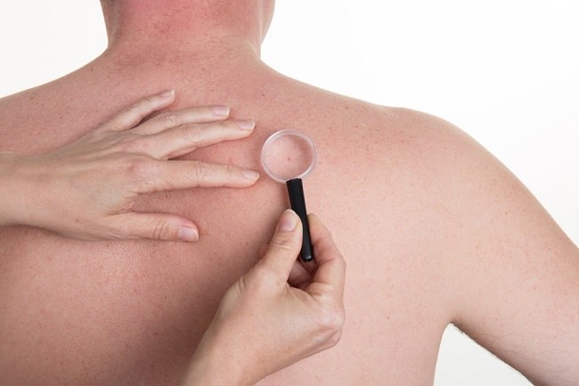  5 Nguyên nhân gây ra bướu ở lưng và cách khắc phục chúng 