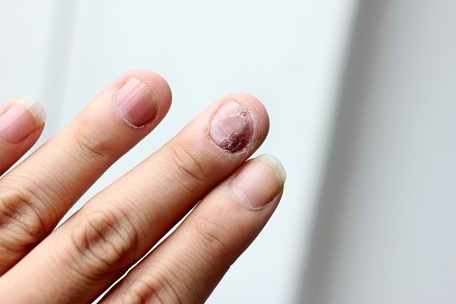 5 Triệu chứng của bệnh vẩy nến móng tay và các bước điều trị-dsuckhoe 