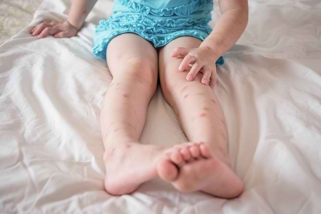  Mẹ ơi, đây là các triệu chứng và cách khắc phục vết cắn trên nệm ở trẻ em-dsuckhoe 