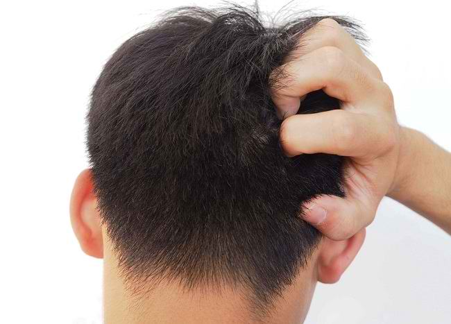  Tìm hiểu nguyên nhân gây ra bệnh chấy tóc và cách chúng lây truyền - dsuckhoe 
