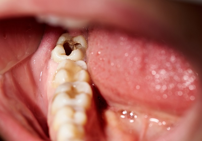  Tìm hiểu Nguyên nhân Sâu răng và Cách Phòng ngừa - dsuckhoe 