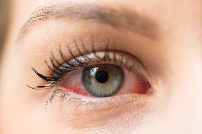  Đây là Nguyên nhân và Cách Phòng ngừa Mắt đỏ - dsuckhoe 