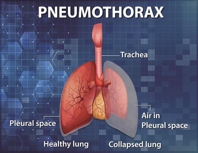 Pneumothorax-dsuckhoe