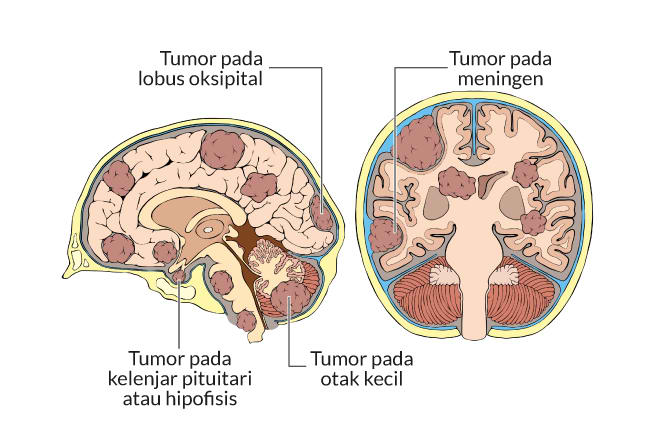  Ung thư não, triệu chứng, nguyên nhân, cách điều trị, cách phòng ngừa, alodokter 
