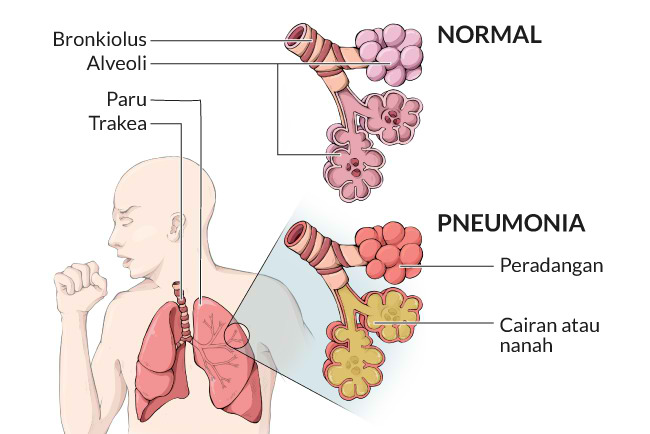  bệnh viêm phổi, triệu chứng, nguyên nhân, cách điều trị, cách phòng ngừa, alodokter 